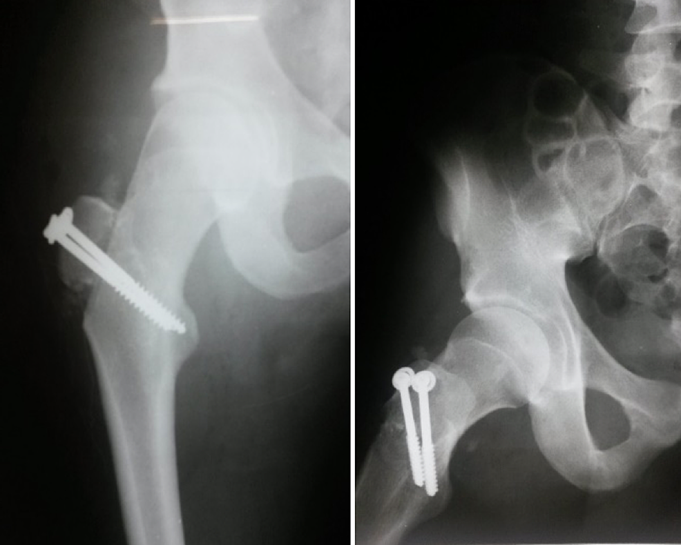 Image-of-a-radiograph-after-surgery,-showing-hip-reduction-and-the-fixation-of-the-greater-trochanter
