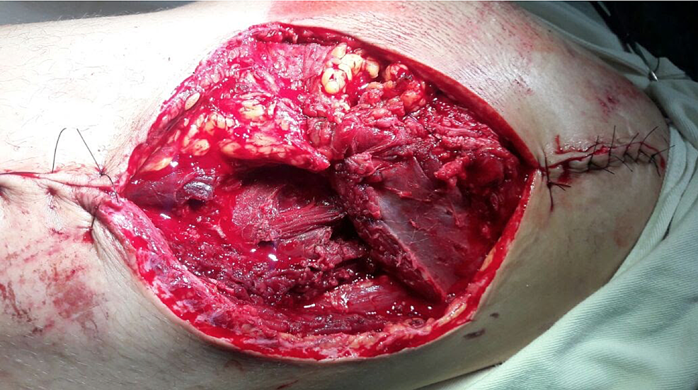 Picture-of-the-wound-after-second-look-surgery