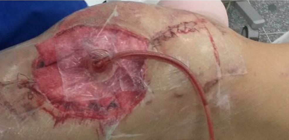 Picture-of-the-vacuum-assisted-closure-of-the-wound