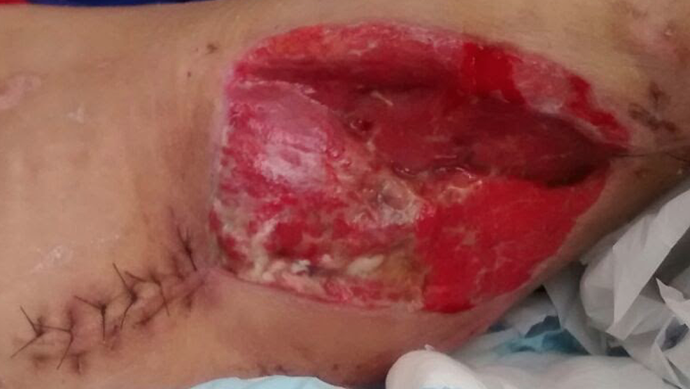 Picture-of-the-wound-after-four-weeks-of-vacuum-assisted-closure