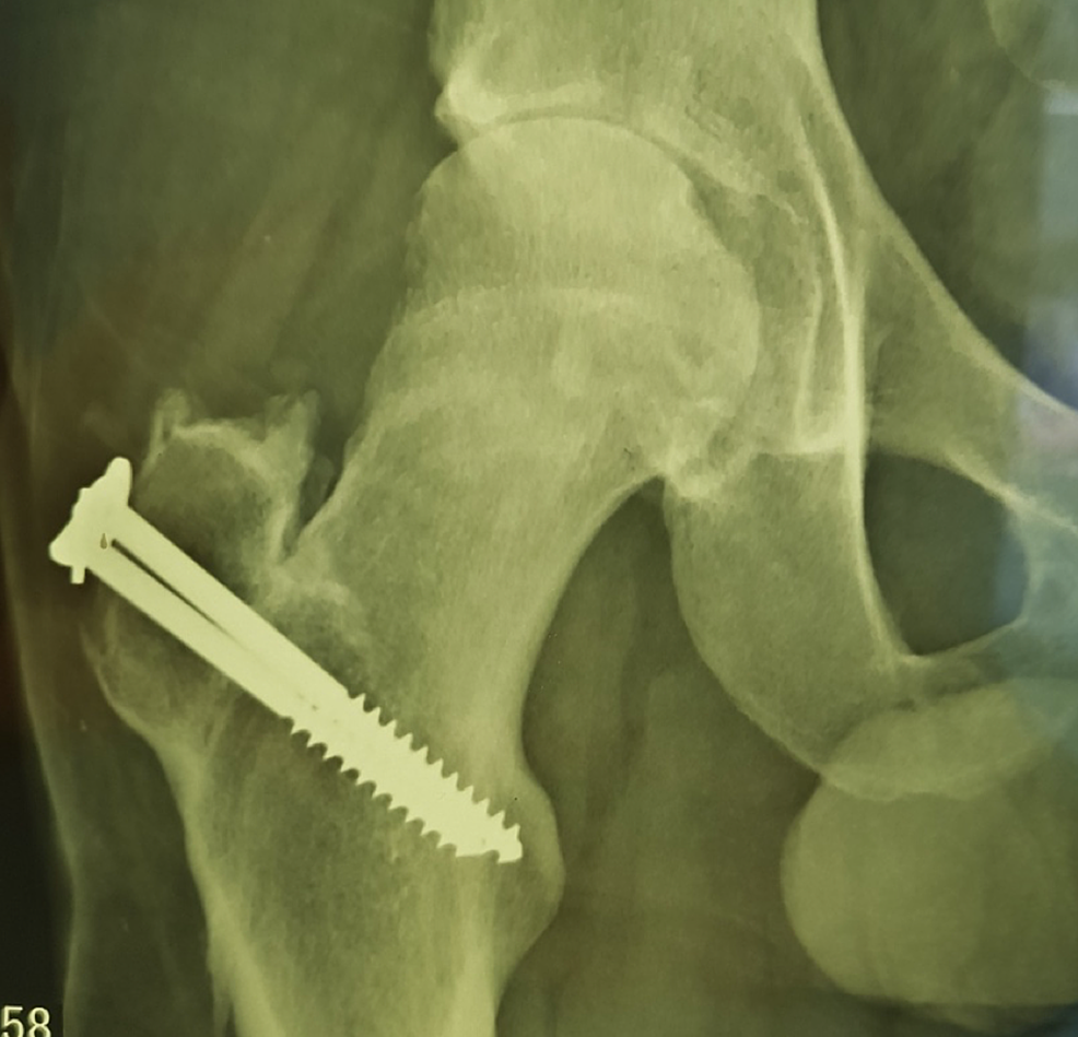 Radiograph-showing-the-healing-of-the-greater-trochanter-fracture-and-a-narrowing-of-the-hip-joint-space