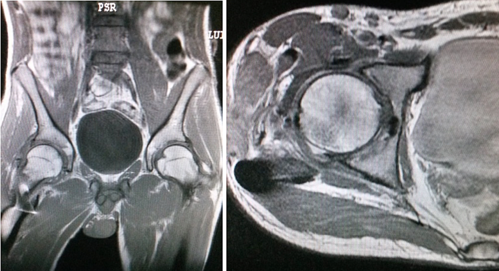 Pictures-of-the-MRI,-showing-the-reduction-of-the-articular-space-and-no-necrosis-of-the-femoral-head