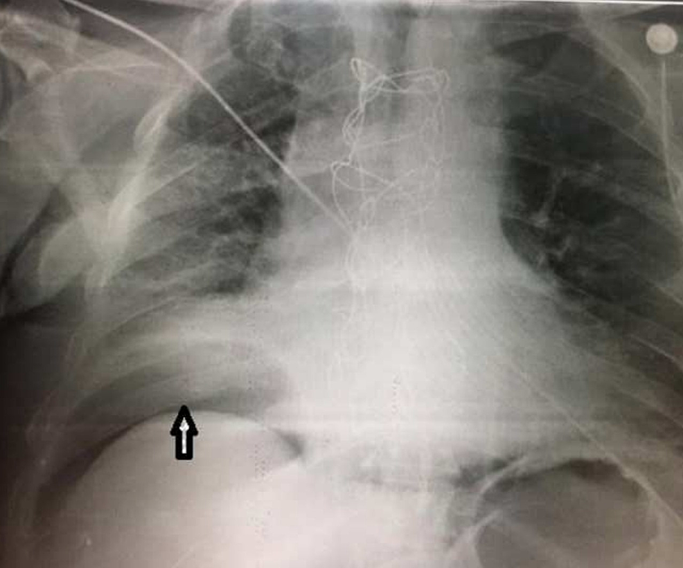 Anterior-posterior-X-ray-made-in-the-ICU