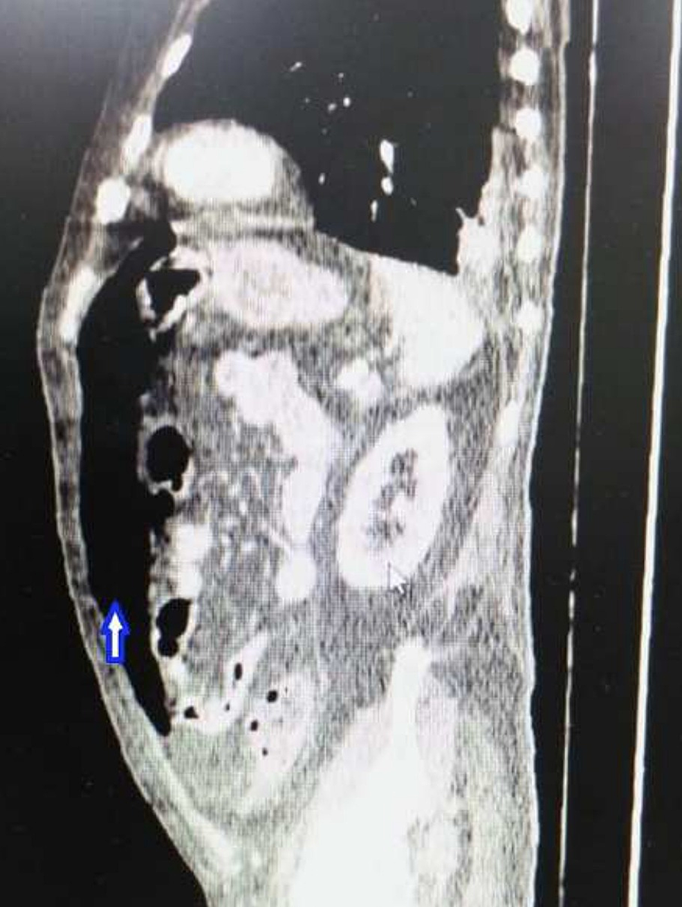 Abdominal-CT-shows-massive-pneumoperitoneum-in-the-anterior-part-of-the-abdominal-cavity