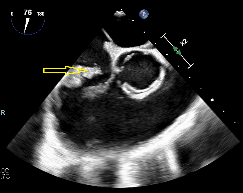 Cureus Successful Debulking of Tricuspid Valve Vegetation Using
