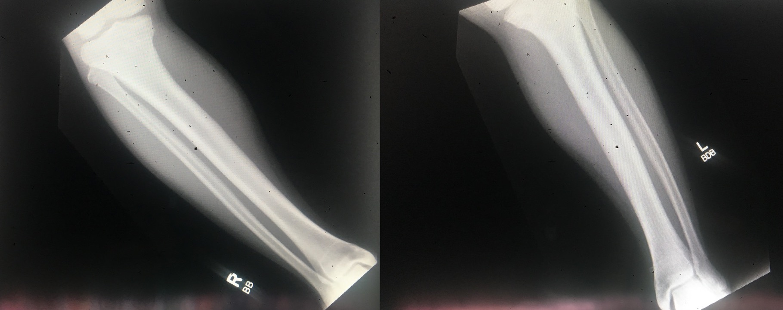 Cureus | Dramatic Transformation After Burosumab in a Young Boy With X ...