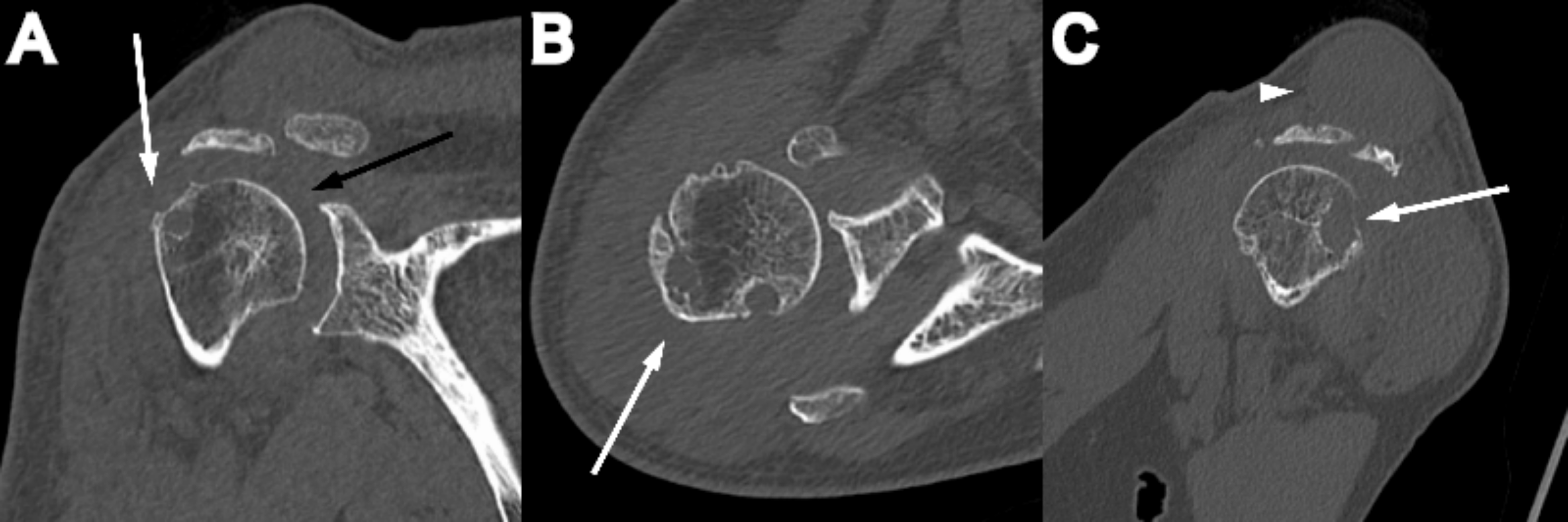 Cureus Cooccurring Acromioclavicular Joint Cyst and Hemarthrosis of