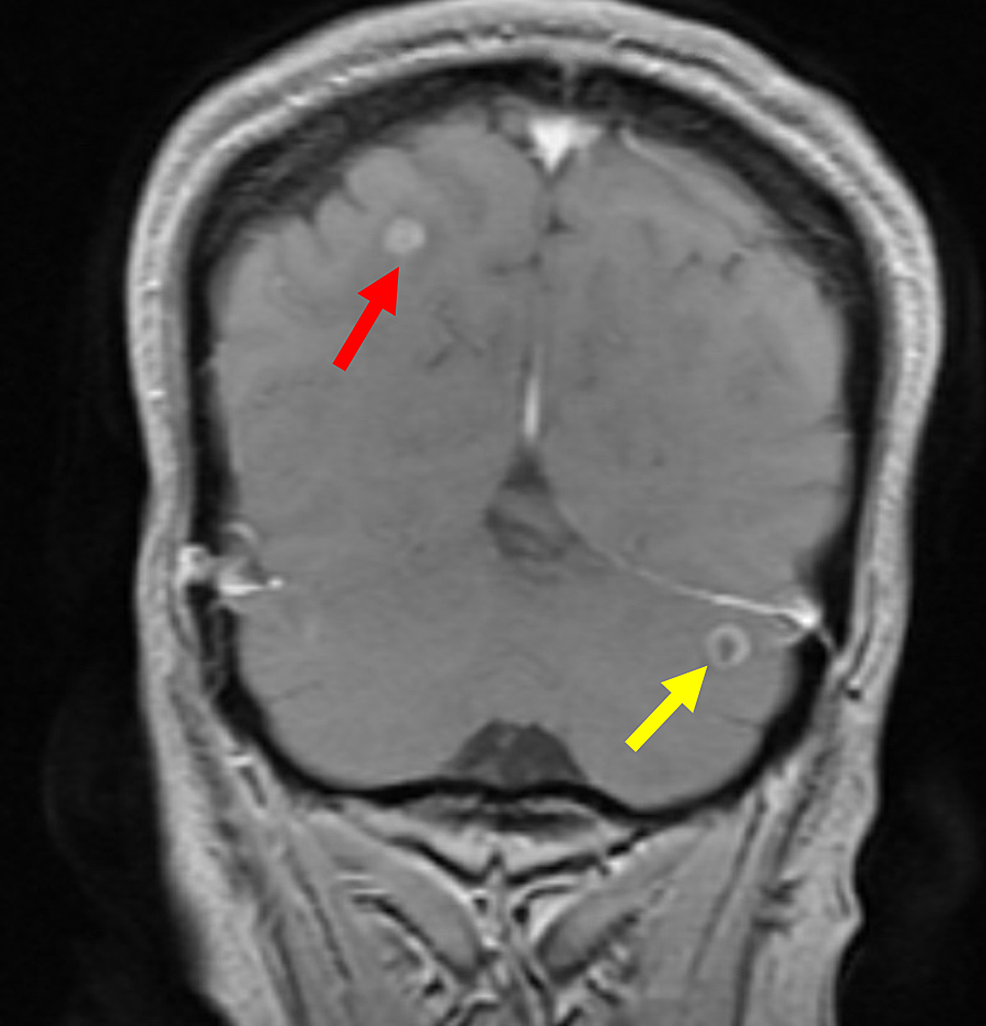 Cureus Shoulder and Upper Back Pain An Unusual Initial Presentation