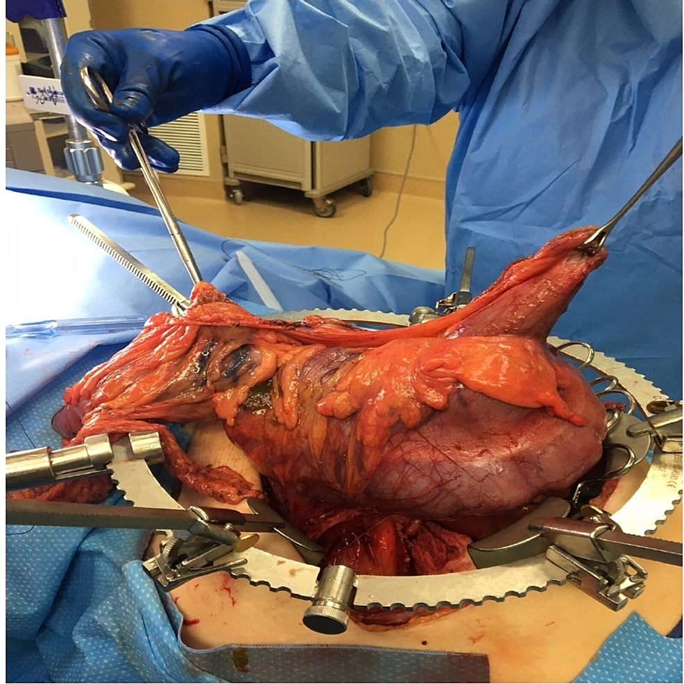 Surgical-resection-of-the-mass