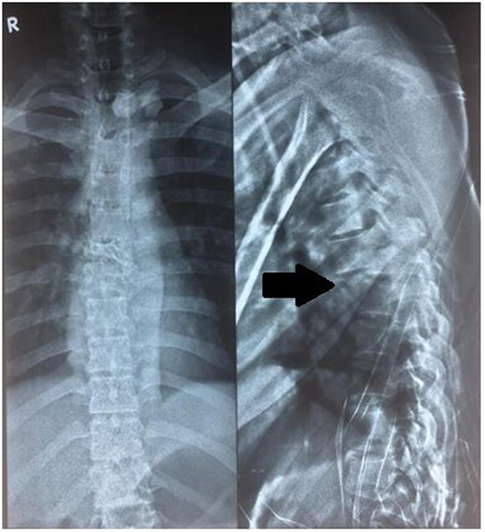 Top 91+ Pictures Where Is T6 Located In The Spine Stunning