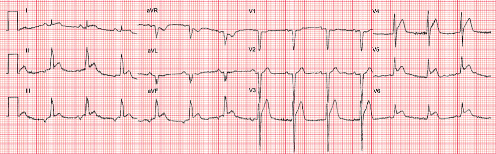 Cureus | Can Milking-Like Effect Be the First Clue of a Ventricular ...