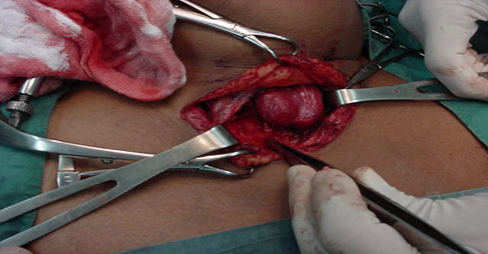 Patient-with-thyroid-hemiagenesis-undergoing-surgery