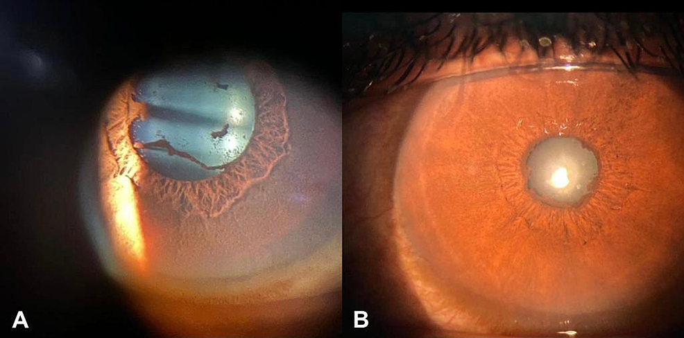 Ocular-findings-of-anterior-acute-uveitis-after-administration-of-COVID-19-vaccine-(A)-and-slit-lamp-photographs-show-mild-vascular-engorgement-of-the-bulbar-conjunctiva-and-posterior-synechiae-(B).