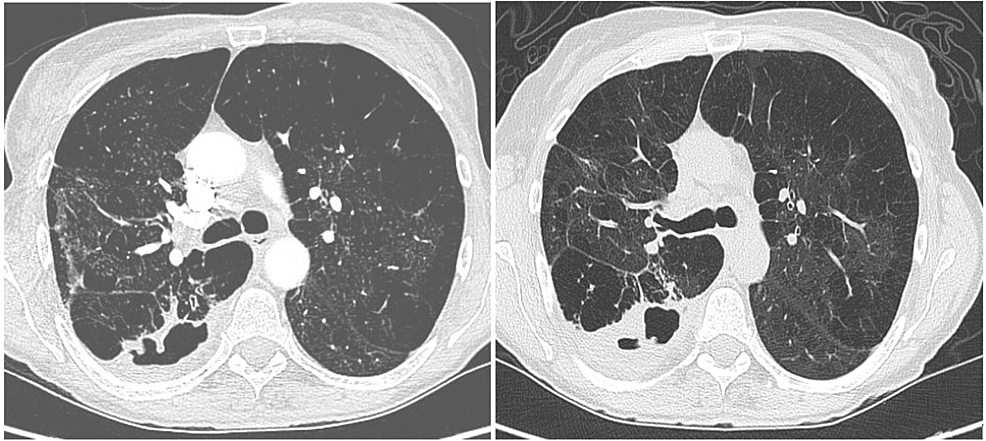Computed-tomography-scan-of-the-chest-at-the-level-of-tracheal-bifurcation-showed-cavitary-lesion-at-the-first-visit-(left)-and-second-visit-(right)