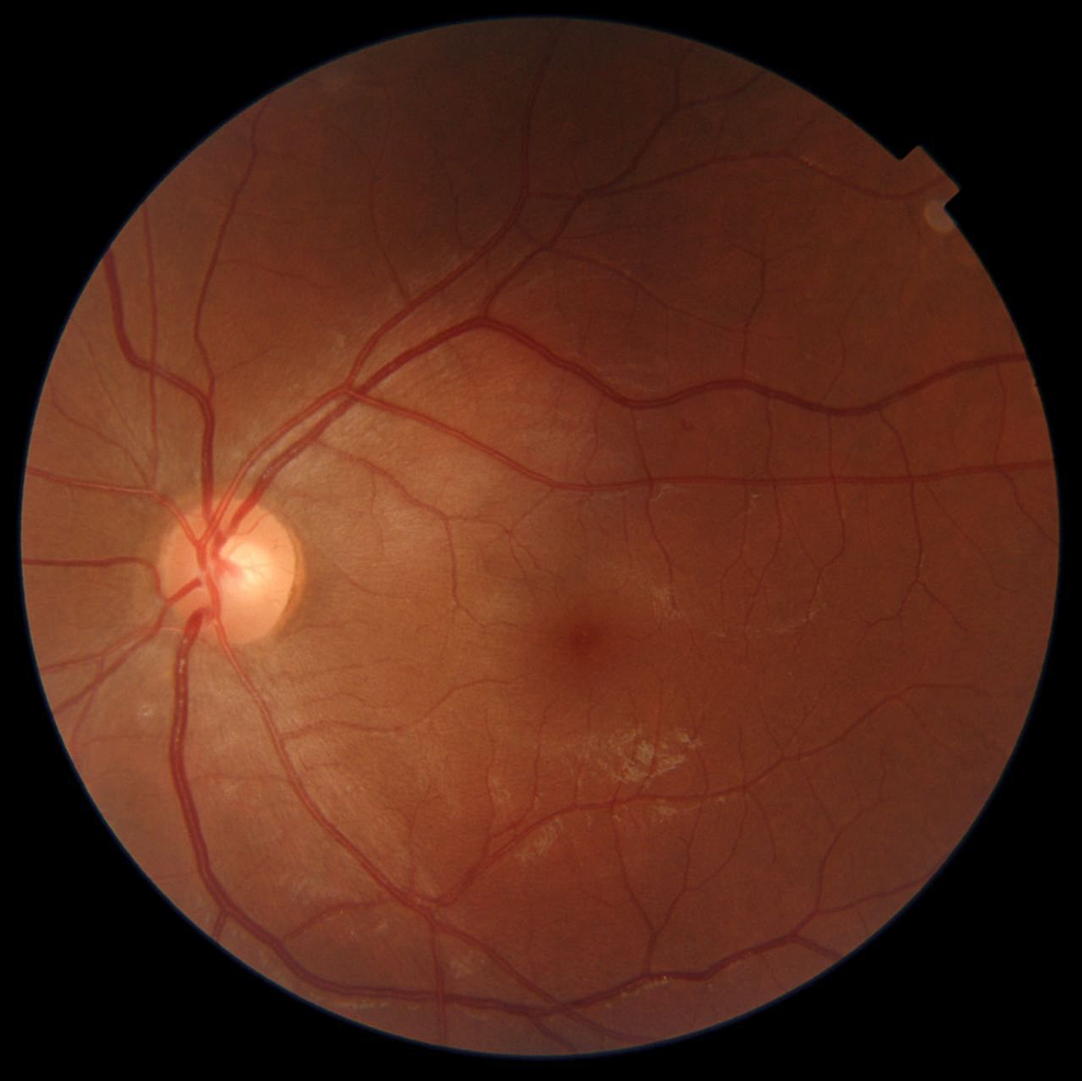 Color-fundus-photography-shows-no-abnormal-finding.