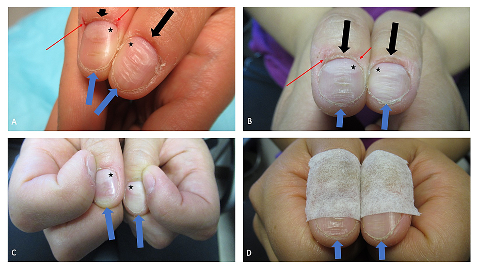 Brittle Nail Syndrome: Background, Symptoms of Brittle Nail Syndrome,  Pathophysiology