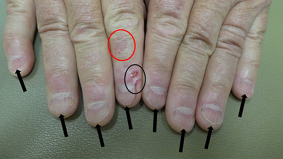 NailAssociated BodyFocused Repetitive Behaviors HabitTic Nail