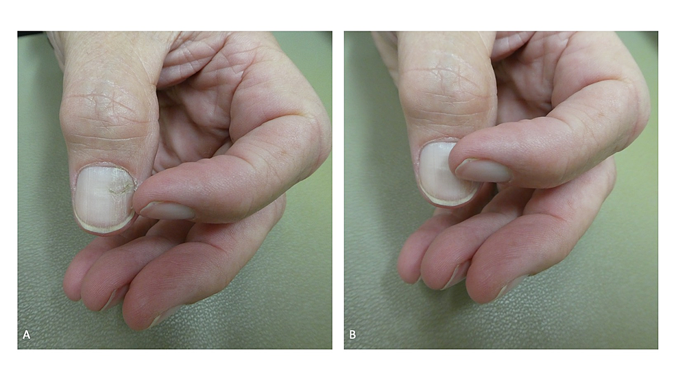 NailAssociated BodyFocused Repetitive Behaviors HabitTic Nail