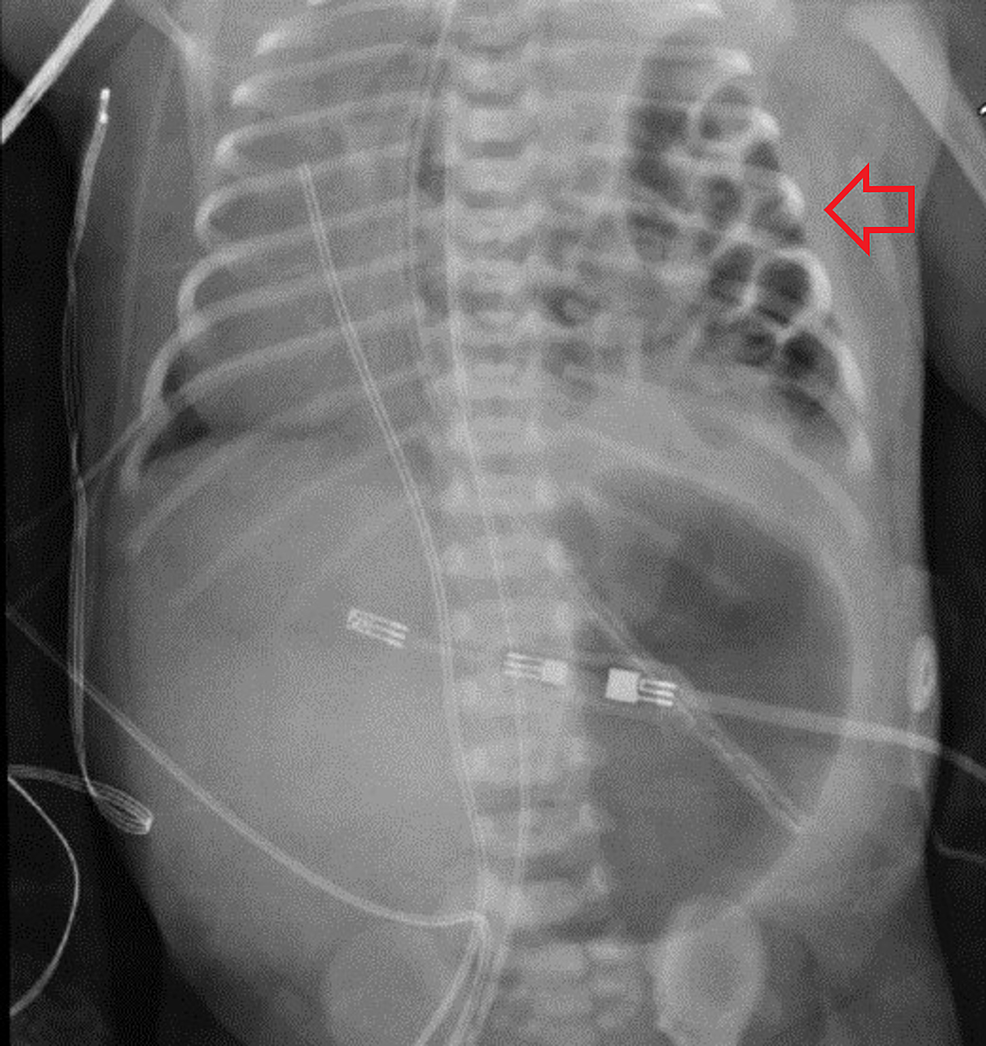 Chest-X-ray-of-the-congenital-diaphragmatic-hernia-(arrow)