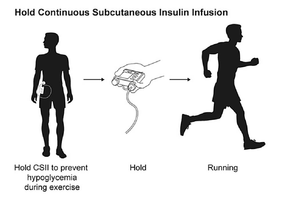 Continuous-subcutaneous-insulin-infusion-management