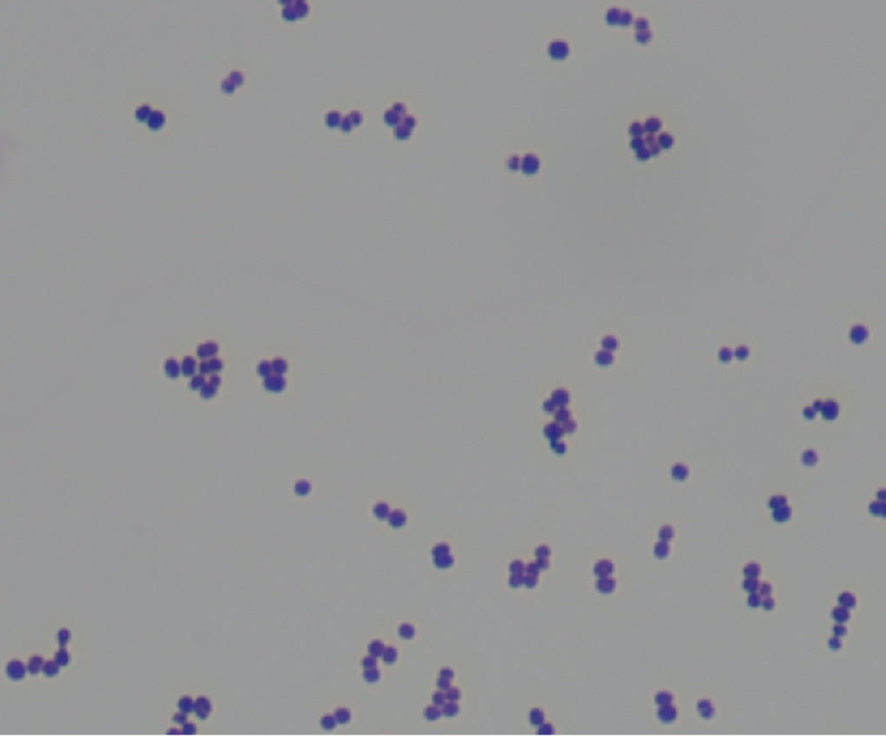 Cureus | Aerococcus urinae Infective Endocarditis