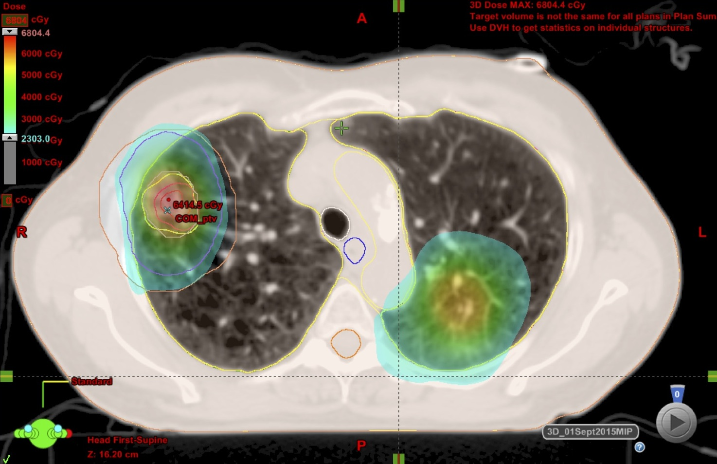 Cureus | SBRT Treatment of Metachronous Small-Cell and Non-Small-Cell