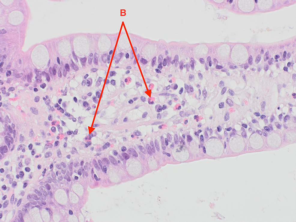 Eosinophils-in-the-lamina-propria-of-terminal-ileum-villi-(examples-labeled-B).