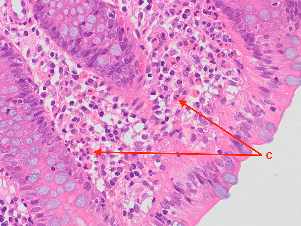 Eosinophils-in-the-right-colonic-lamina-propria-(examples-labeled-C).