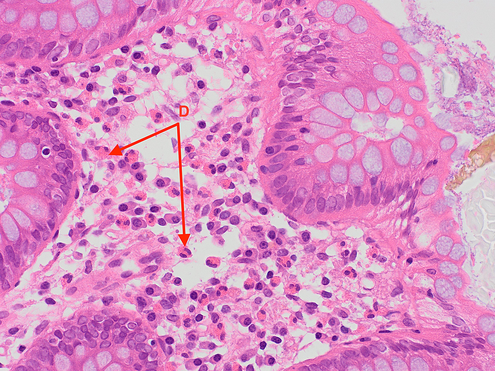 Eosinophils-in-the-right-colonic-mucosa-(examples-labeled-D).