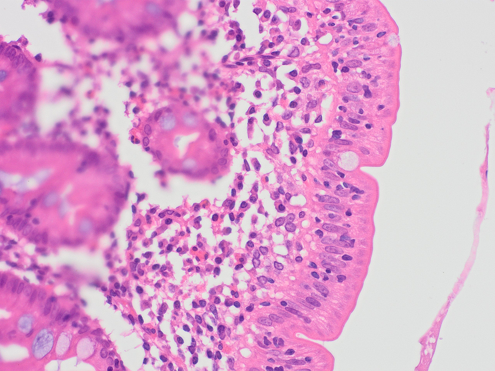 Intraepithelial-lymphocytes-in-D2-duodenum.