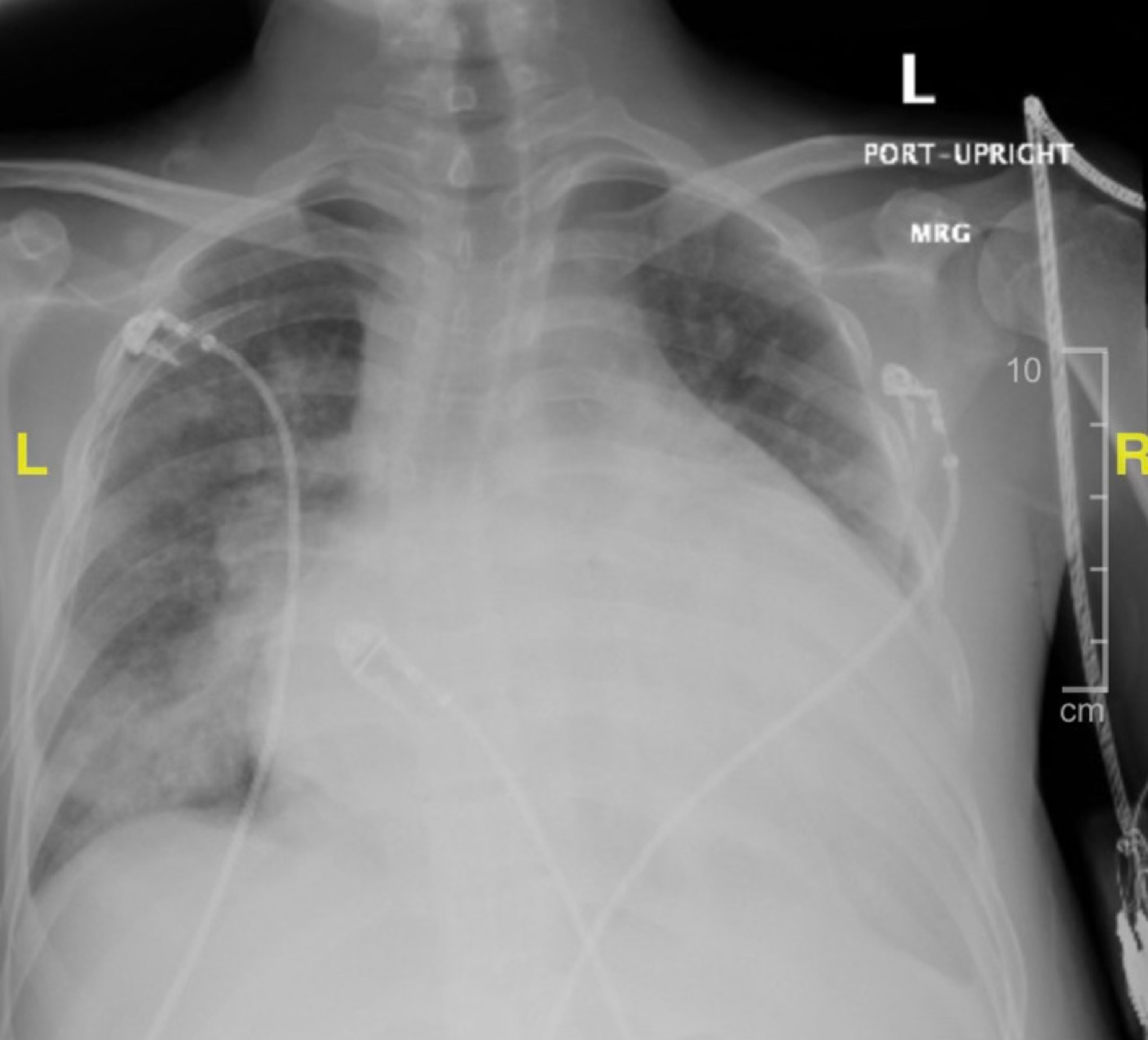 Cureus A Rare Case of Purpura Fulminans in the Setting of Klebsiella