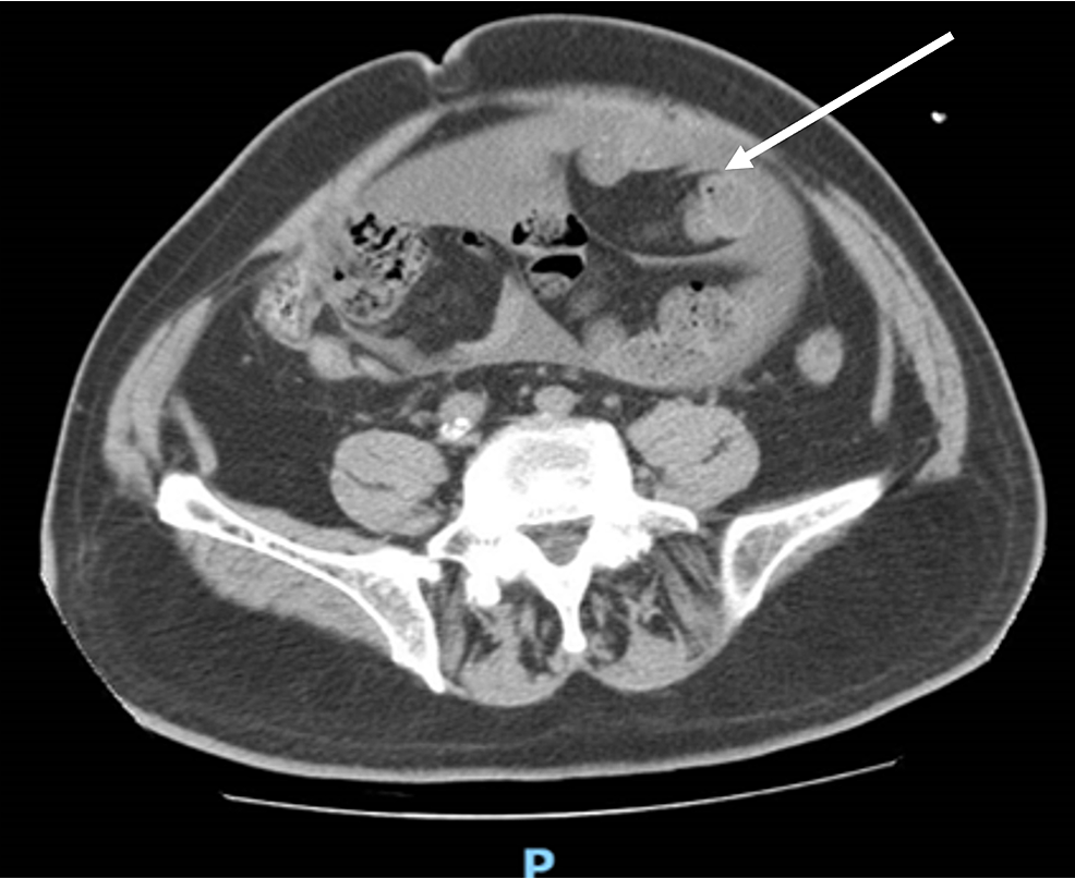 Cureus Abdominal Cocoon Syndrome A Rare Cause of Intestinal