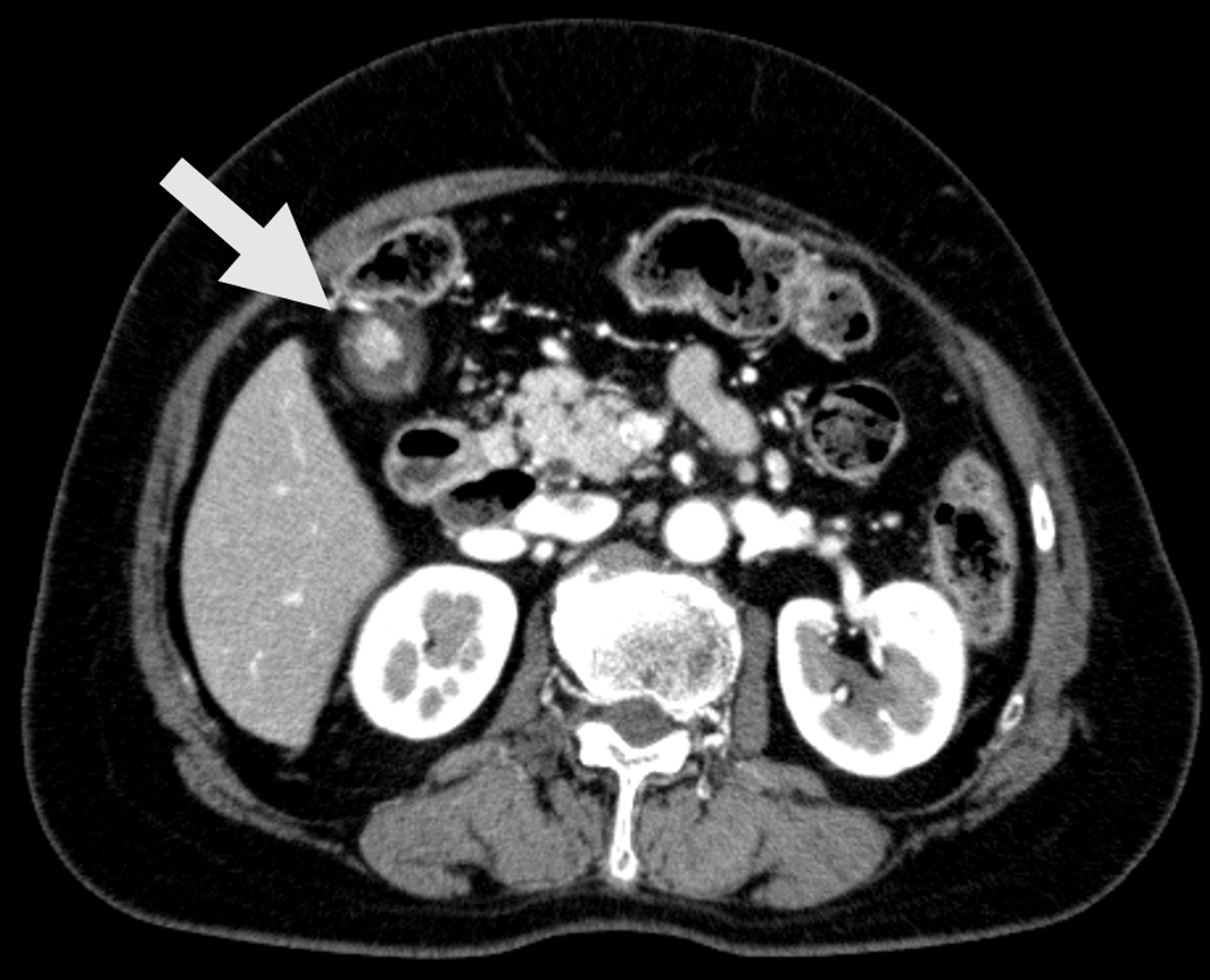Cureus Gallbladder Intramucosal Carcinoma Arising in a Cholesterol