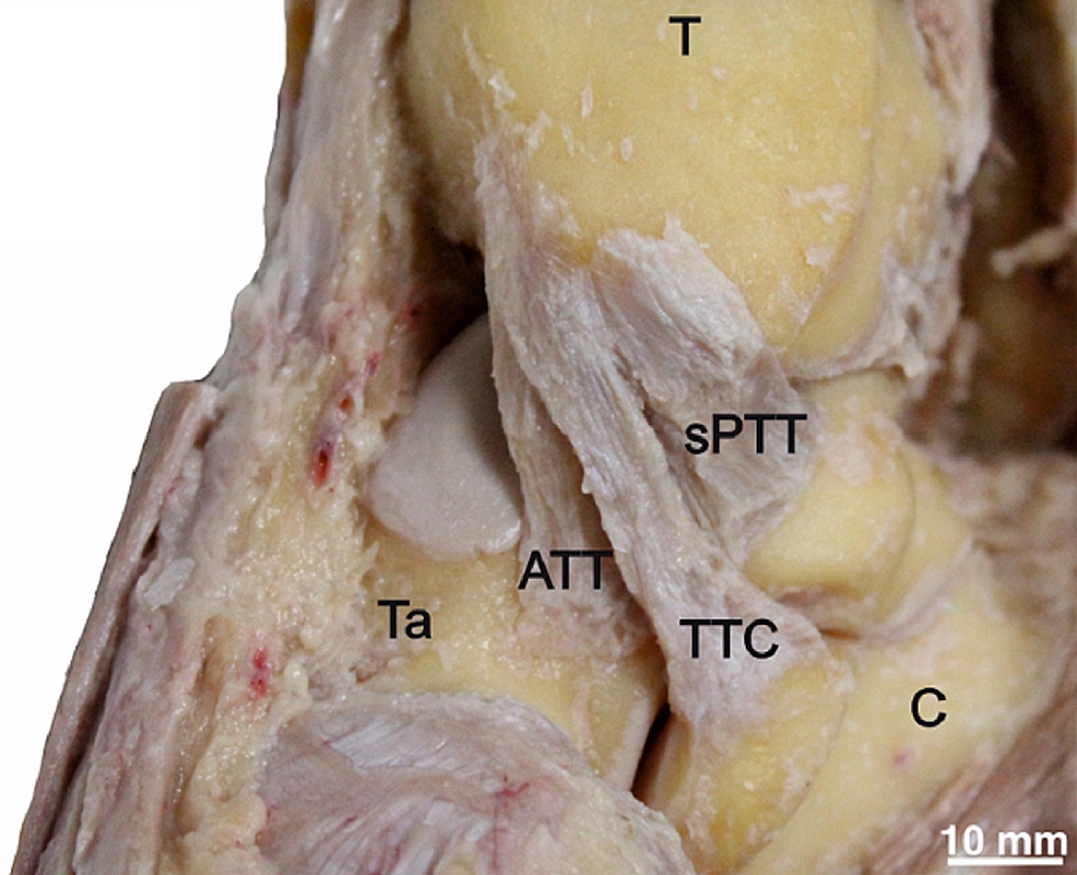 The ligament anatomy of the deltoid complex of the ankle: a