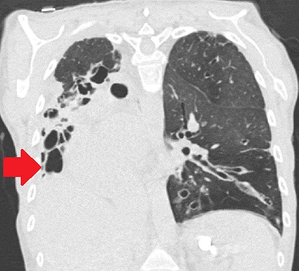 CT-chest-coronal-view-shows-lower-lobe-predominant-bronchiectasis,-heart-deviated-to-the-right-with-extreme-right-lung-destruction-(red-arrow)