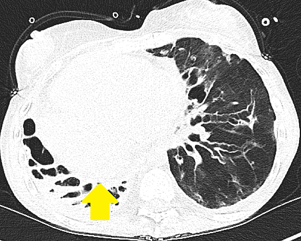 CT-chest-axial-view-shows-bronchiectasis-with-extreme-right-sided-deviated-mediastinal-structures-(yellow-arrow)