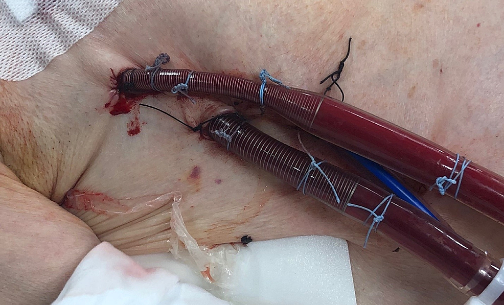 Direct-central-ambulatory-VA-ECMO-shows-utilizing-a-minimally-invasive-approach-via-right-anterior-thoracotomy-in-the-right-second-intercostal-space