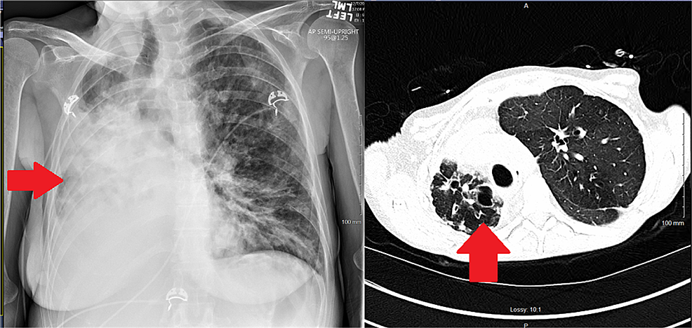 Preoperative-imaging-with-an-extreme-mediastinal-shift-(red-arrows)