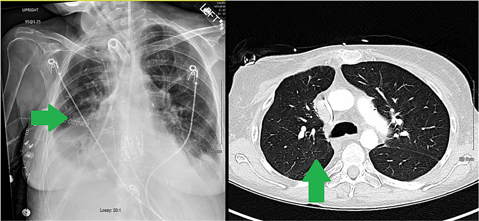 Post-transplant-imaging-with-the-resolution-of-mediastinal-shift-(green-arrows)