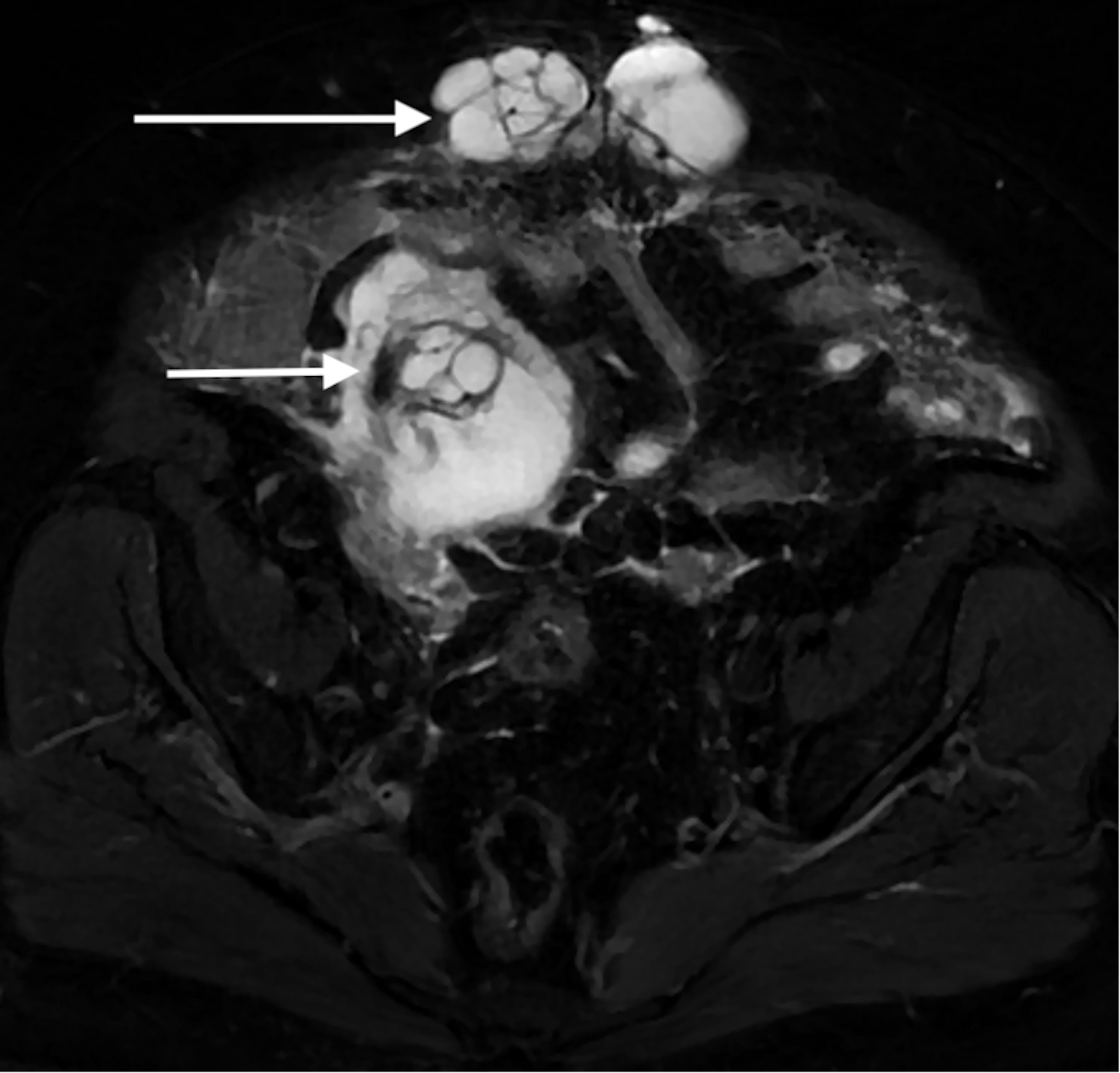 Cureus Ruptured Appendiceal Mucocele Presenting as a Ventral Hernia