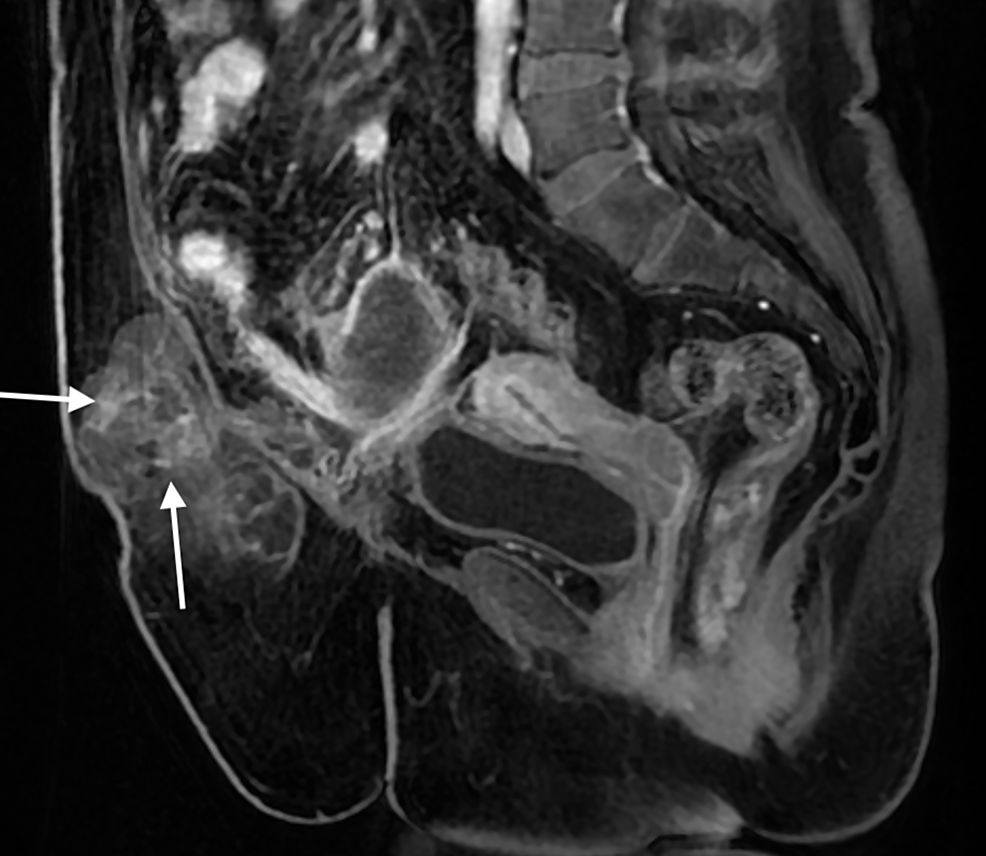 Ruptured Appendiceal Mucocele Presenting as a Ventral Hernia A Case