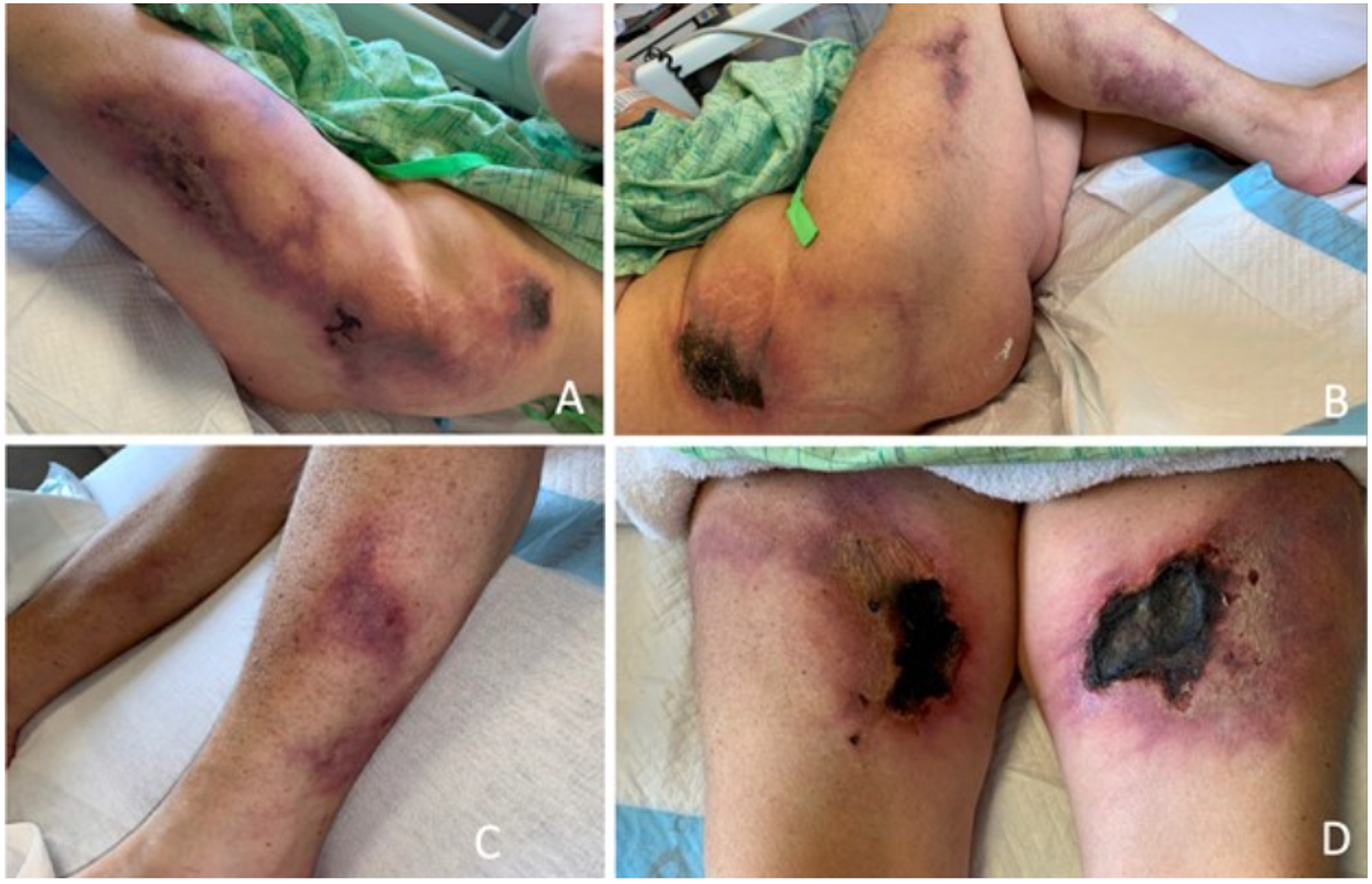 early early stage calciphylaxis