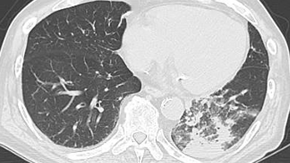 Initial-chest-computed-tomography-scan-showing-opacity-in-the-left-lower-lung-zone-at-admission.