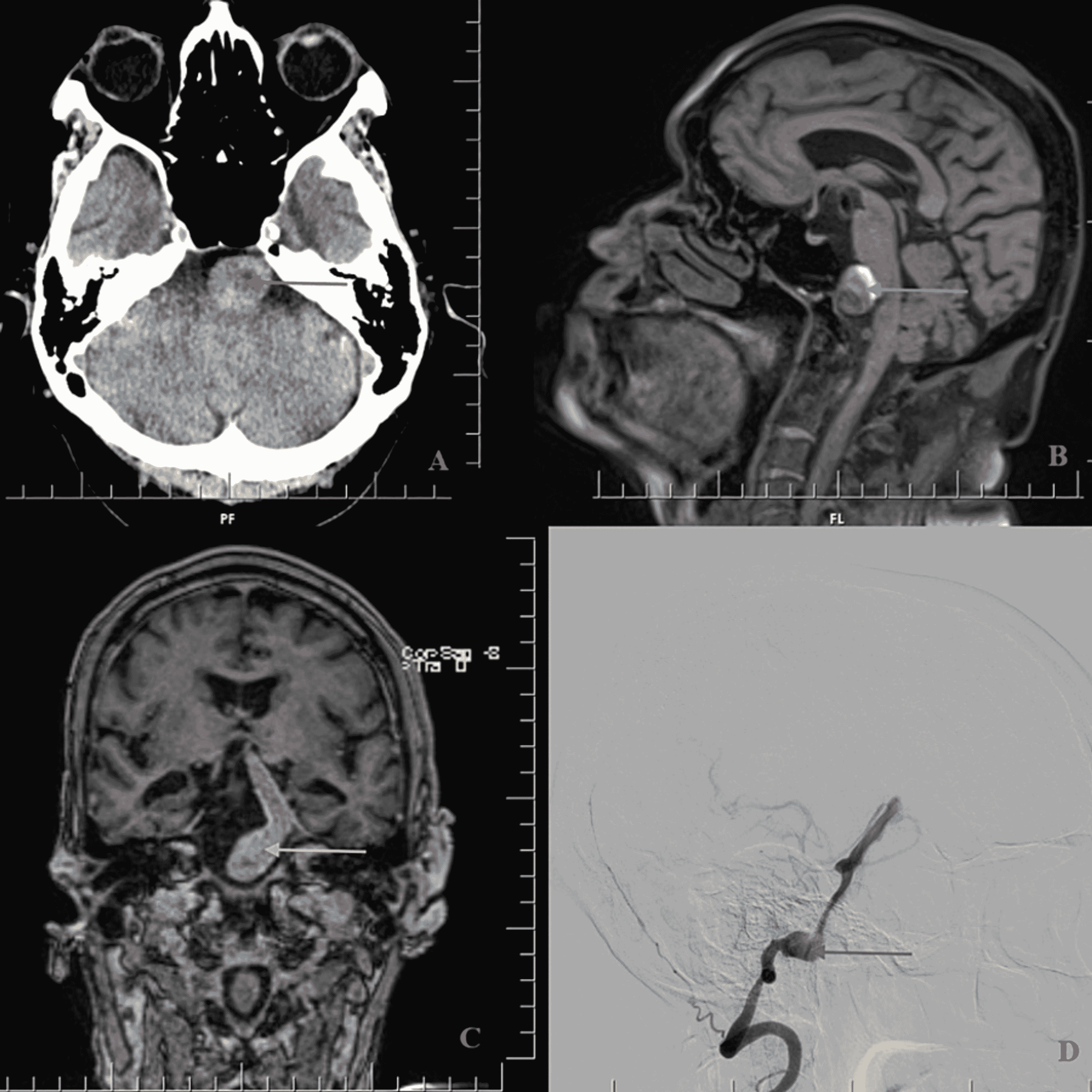 cureus-transient-ischemic-attack-due-to-unruptured-basilar-artery