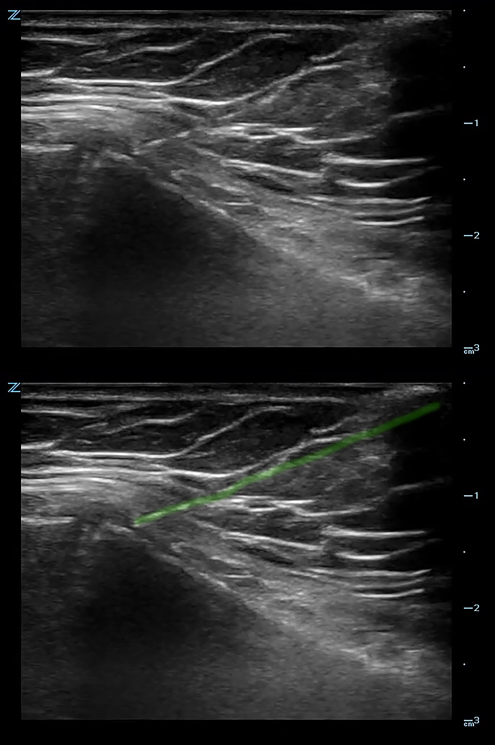 Ultrasound-image-of-in-line-needle-insertion-in-the-hematoma-overlying-the-fracture.-The-needle-is-highlighted-(green).