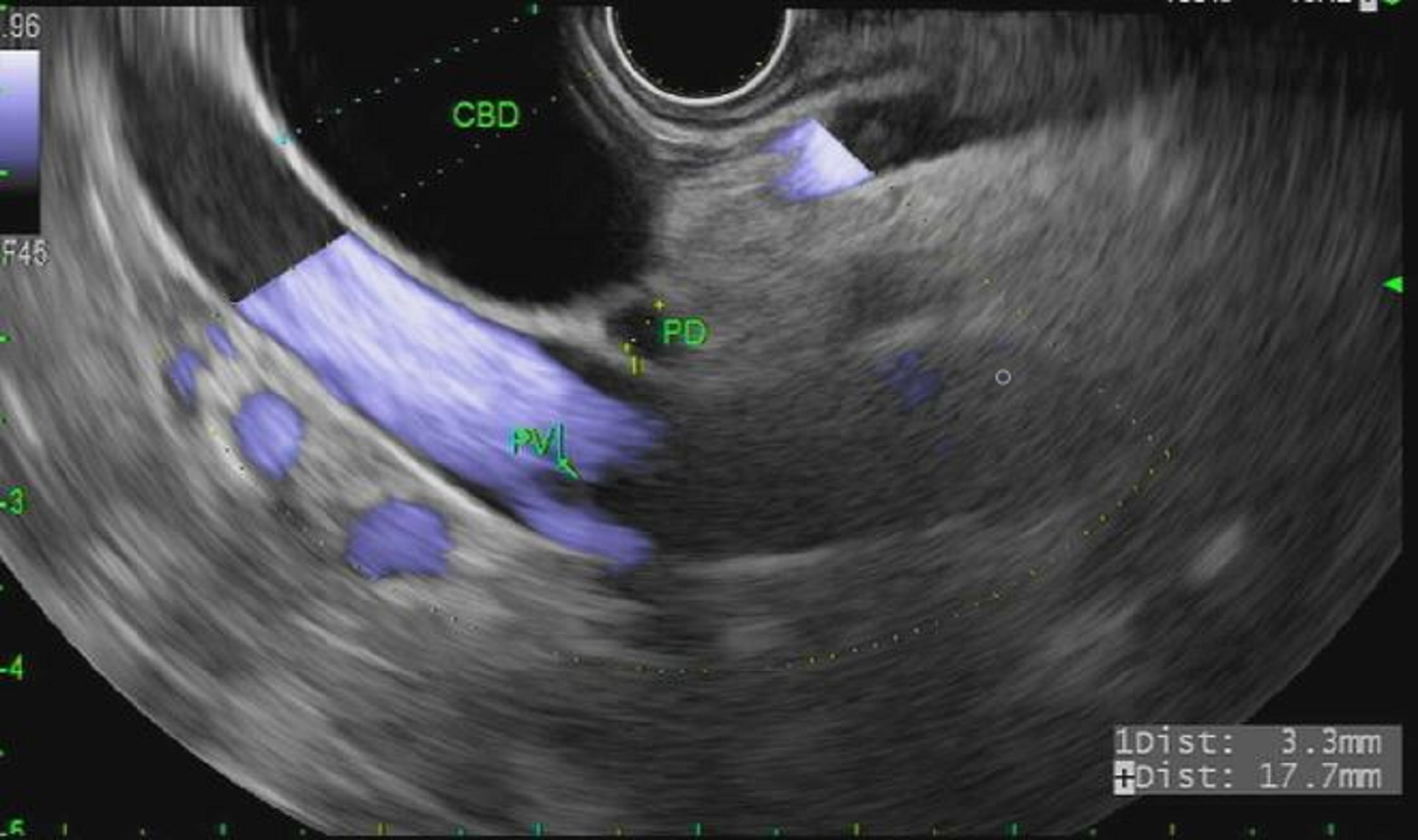 Cureus Preoperative Endoscopic UltrasoundGuided Hepaticogastrostomy