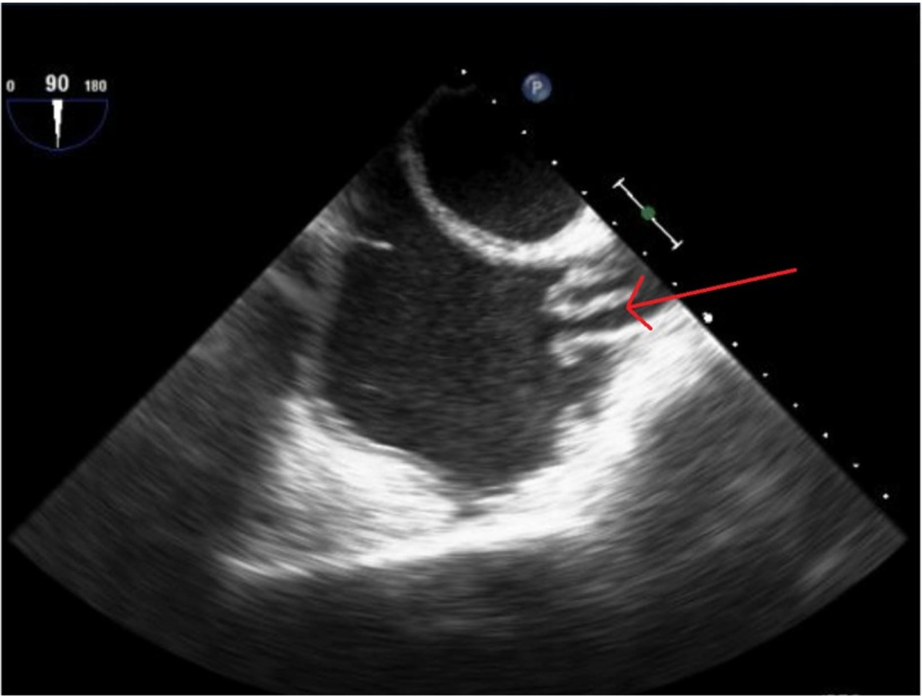 Cureus | Endovascular Endocarditis Within the Superior Vena Cava of a ...