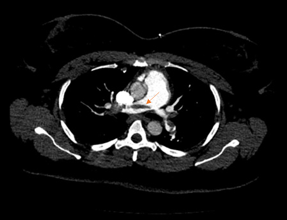 Computed-tomographic-angiography-of-the-chest-(axial-view)