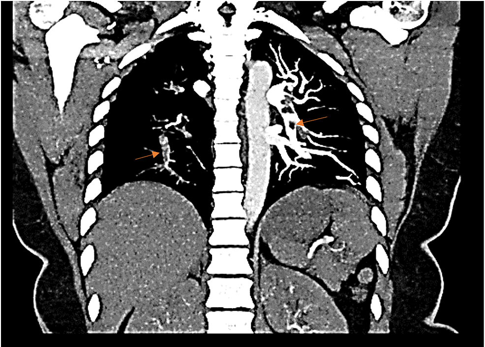 Computed-tomographic-angiography-of-the-chest-(coronal-view).