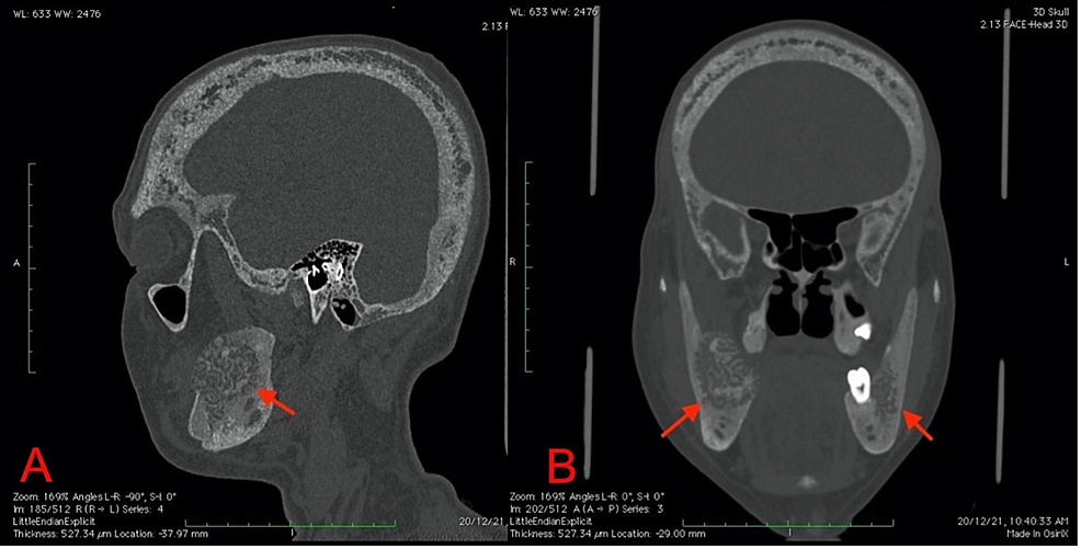Sagittal-(A)-and-coronal-(B)-CT-in-the-bone-window-show-the-lesions-with-associated-diffuse-osteopenia-of-the-skull